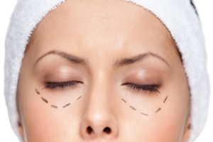 BLEFAROPLASTIA